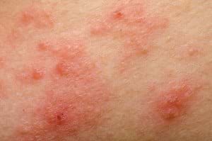 Eczema Atopic Dermatitis