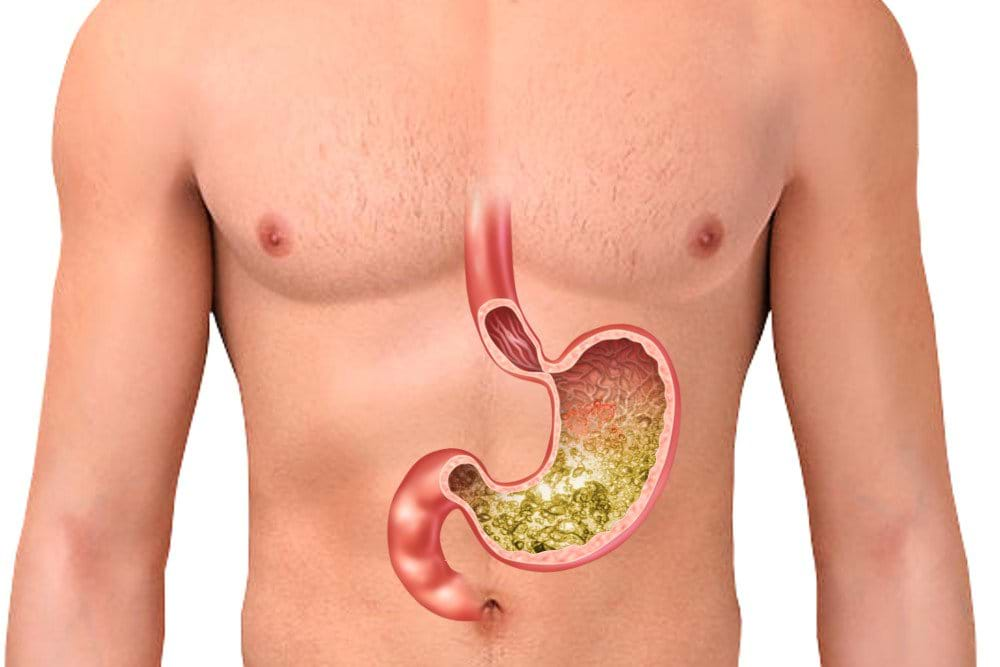 Does Acid Reflux Make Your Stomach Sore